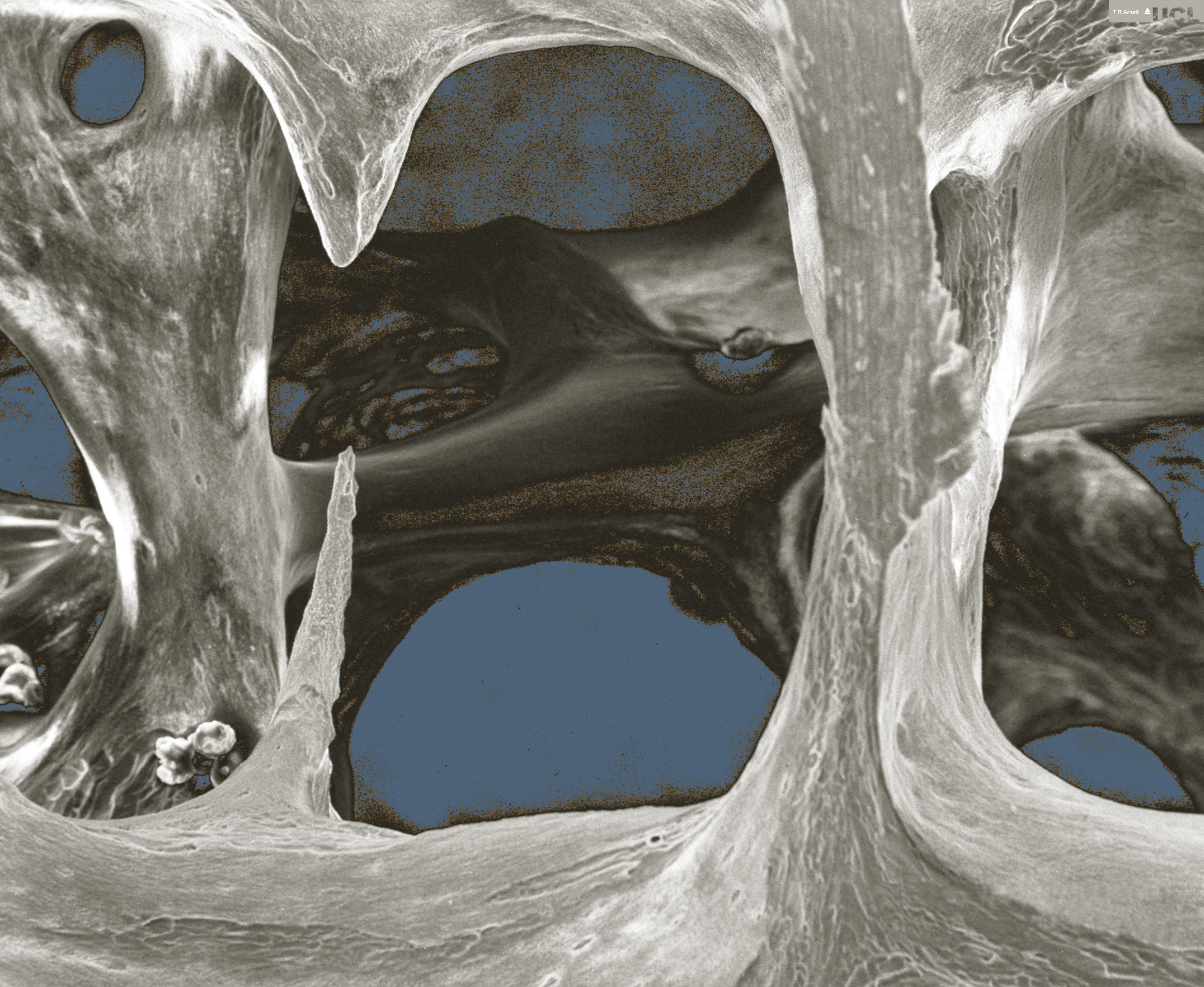 Bone Prone? Shocking New Research Reveals Why - v9g9e0f