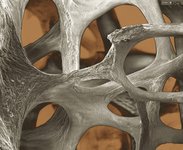 Osteoporotic bone architecture
