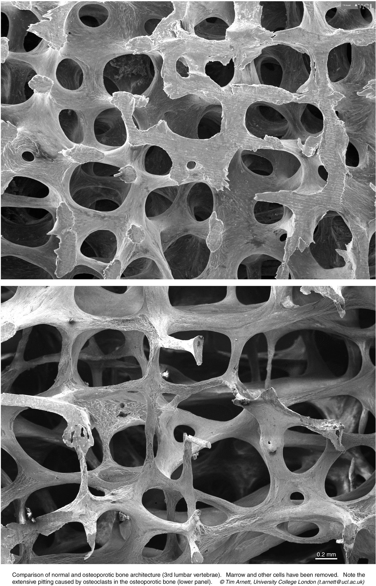 Comparison of normal and osteoporotic bone architecture - Bone Research