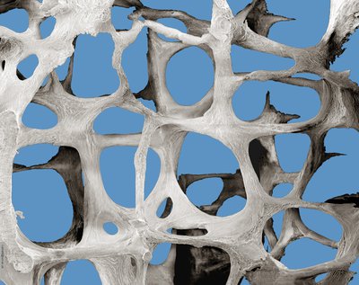 Scanning Electron Microscopy of osteoporotic bone