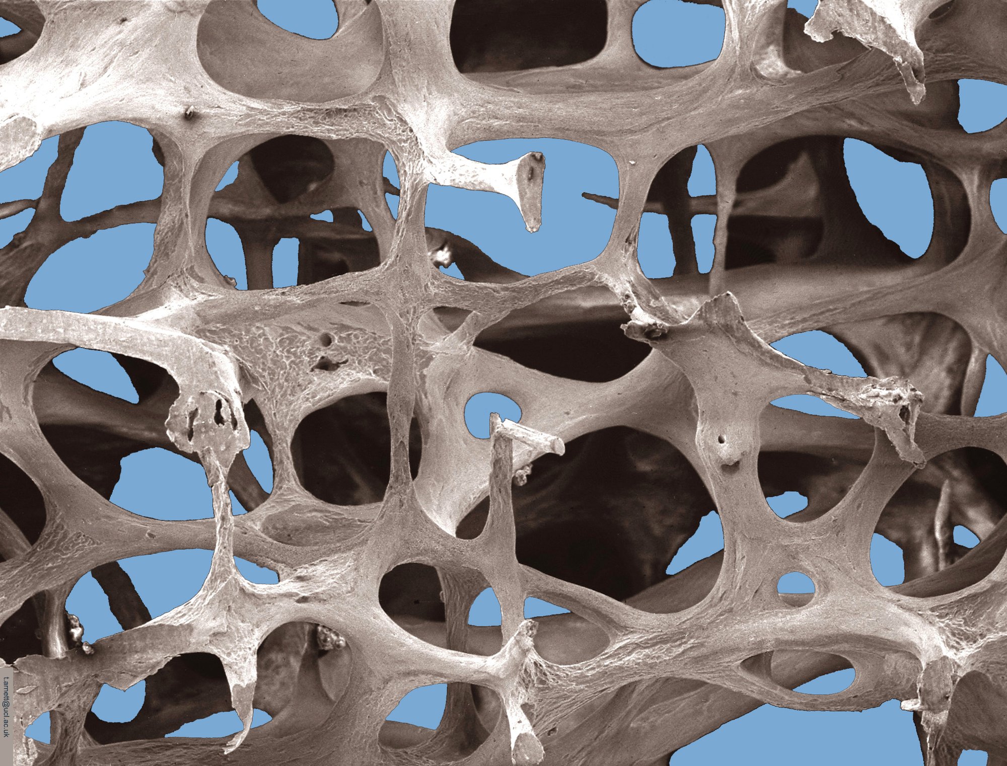 Scanning Electron Microscopy of osteoporotic bone